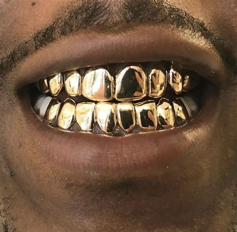 Gold Teeth: From Ancient Times to the Present Day
